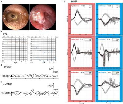 Case Report: Suppurative Labyrinthitis Induced by Chronic Suppurative Otitis Media